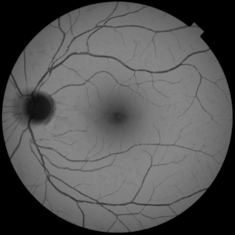 Lado direito: o mesmo olho em autofluorescência, em tons de cinza, com o nervo óptico escuro e a mácula mais escura no centro.